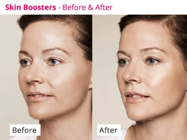 skinboosters-before-after-treatment-almancil-faro-algarve skinboosters before and after treatment