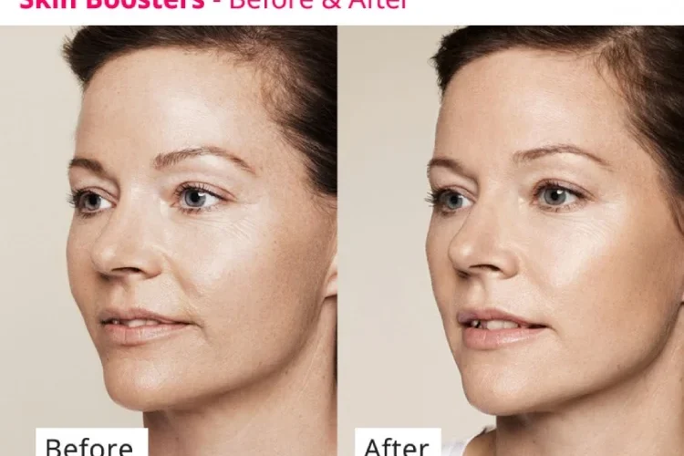 skinboosters before and after treatment
