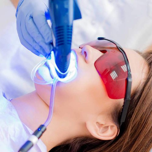 Branqueamento Dentário a laser em Almancil, Algarve