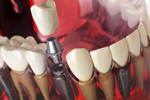 carga imediata dentes fixos carga imediata dentes fixos