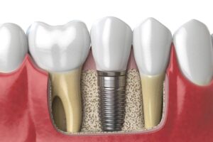 implantes dentarios
