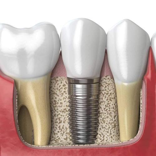 implantes dentários dentes