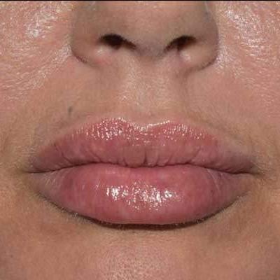 botox labios