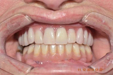 dentes implantes algarve
