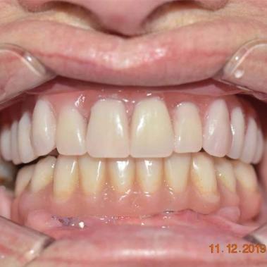 dentes implantes algarve