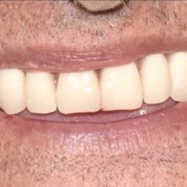 implantes dentários algarve