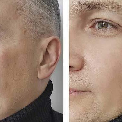 botox homens cara testa olhos