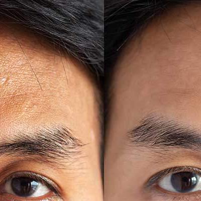 botox homens testa