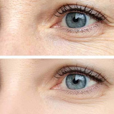 botox mulheres olhos