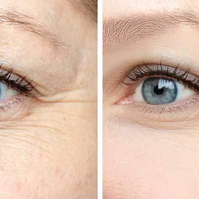 botox mulheres olhos