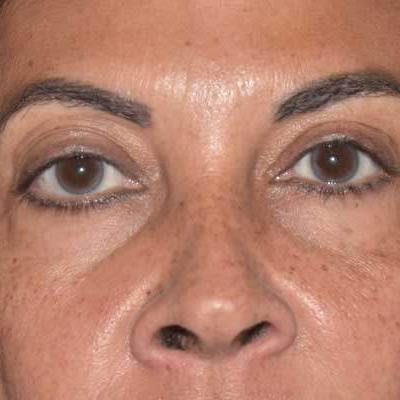 botox mulheres olhos