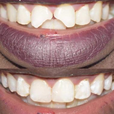 dental veneers : facetas dentárias