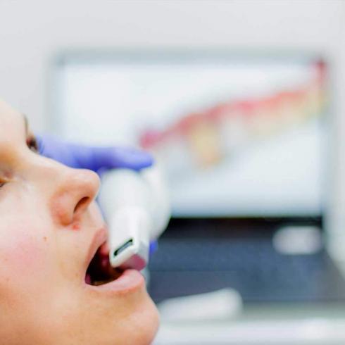 dentista scanner 3d moldagem digital