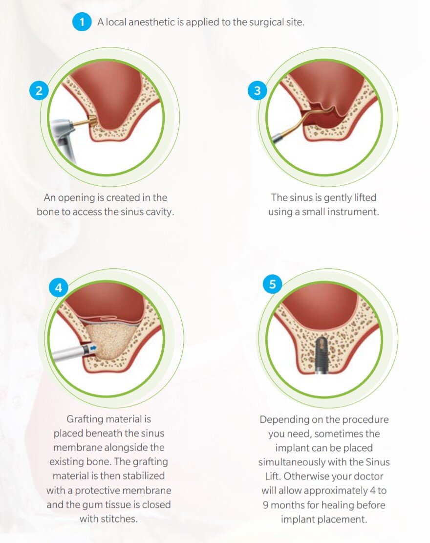 sinus lifting
