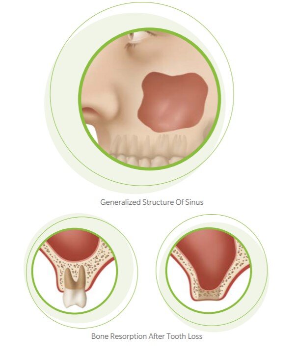 sinus lift