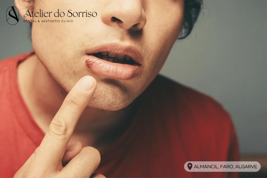 cold sores algarve faro almancil