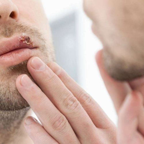 herpes tratamento prevenção
