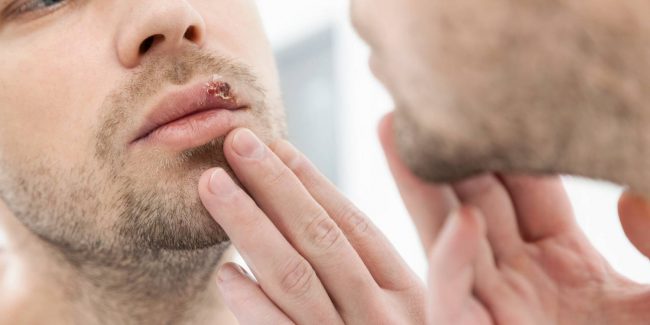herpes-tratamento-prevencao herpes tratamento prevenção