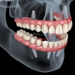 all on four implant: immediate load