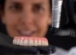 implantes dentários