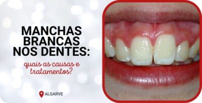 causas manchas brancas dentes tratamentos