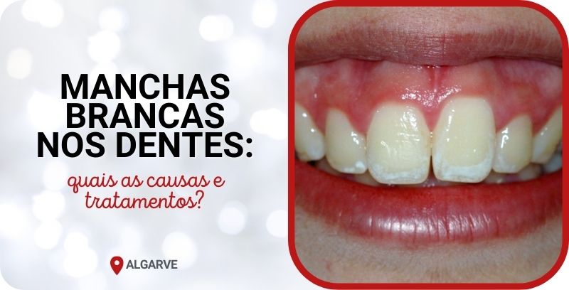 causas manchas brancas dentes tratamentos