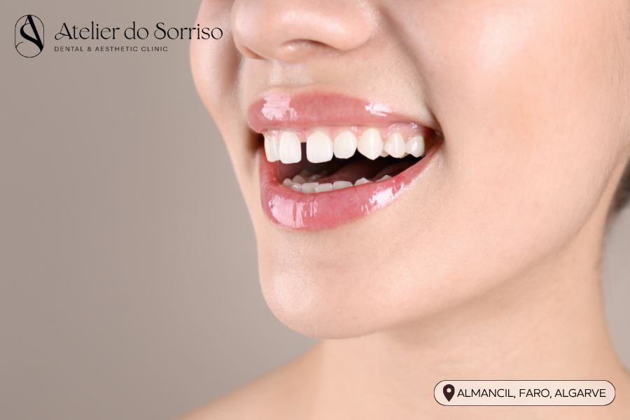 dentista fechar diastema algarve faro almancil