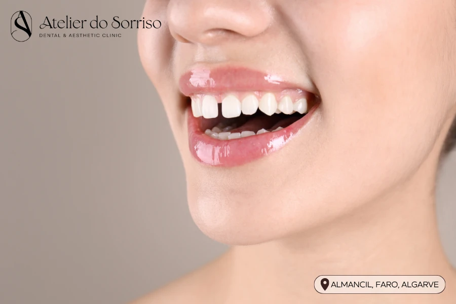 dentista-fechar-diastema-algarve-faro-almancil dentista fechar diastema algarve faro almancil