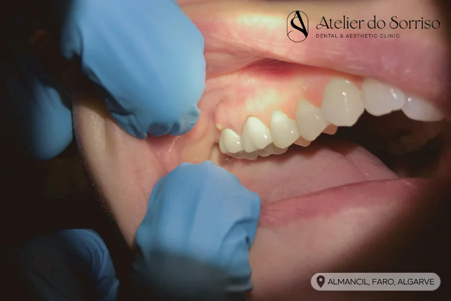 tratar abcesso dentario abcesso gengival algarve faro almancil