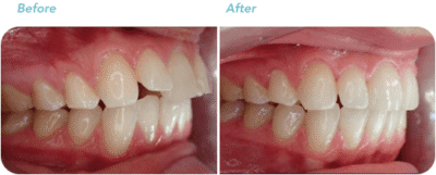 invisalign before after treatment