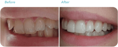 invisalign before after treatment