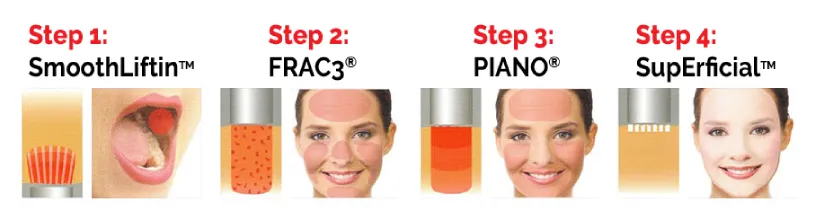 fotona-4d-steps-clinic-almancil-faro-algarve