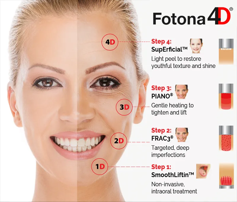 how does laser fotona D works algarve faro almancil