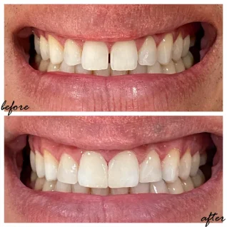 dental veneers faro facetas almancil algarve