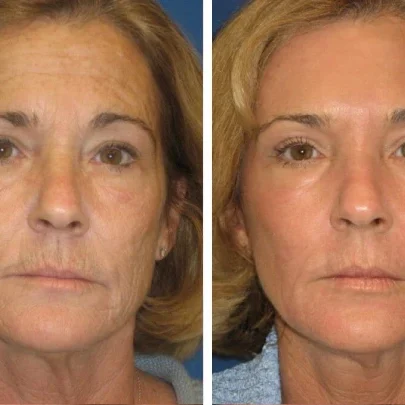 Resultados Antes e Depois do Laser Fotona 4D em Almancil, Faro, Algarve