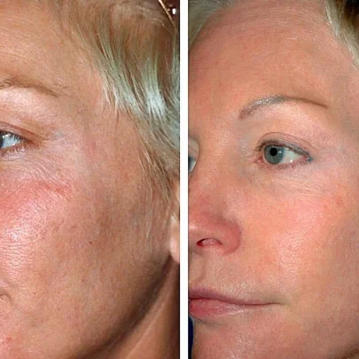 Antes e Depois Fotona Laser em Portugal