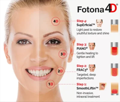 laser fotona D etapes algarve faro almancil laser fotona D etapes algarve faro almancil
