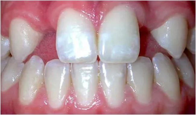 tratamento-agenesia-dentaria-algarve