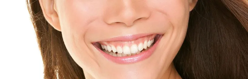 gummy-smile-sorriso-gengival-faro-algarve-atelier-do-sorriso-002