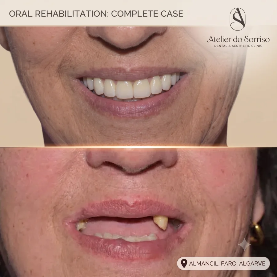 caso antes depois reabilitacao dentes fixos horas all on four algarve