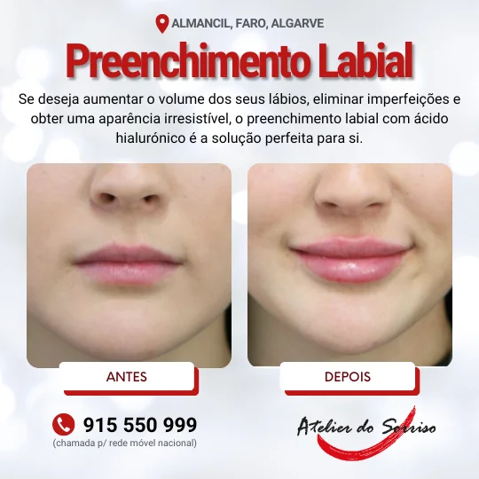 preenchimento-labial-faro-algarve-atelier-do-sorriso-almancil