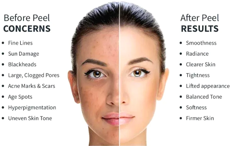 chemical-peel-benefits-skin-algarve-faro-almancil-01
