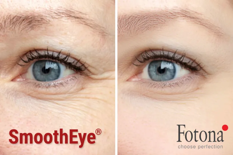 Smooth-Eye-Fotona-Antes-Depois-Algarve Smooth Eye Fotona Antes Depois Algarve