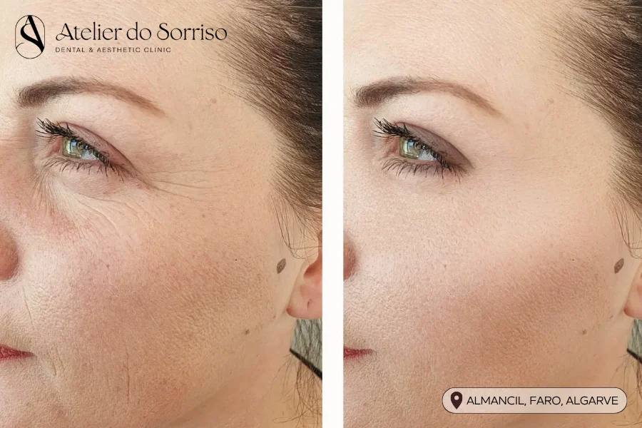 fotona tratament olhos smooth eye algarve faro almancil