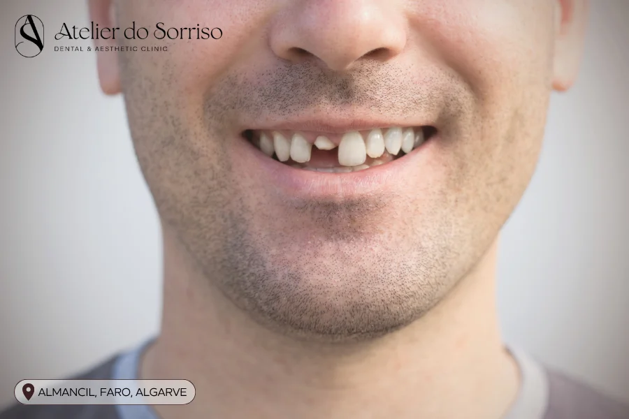 parti dente fratura algarve faro almancil