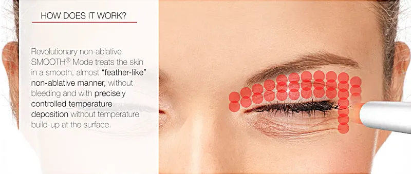 smooth-eye-fotona-laser-how-it-works