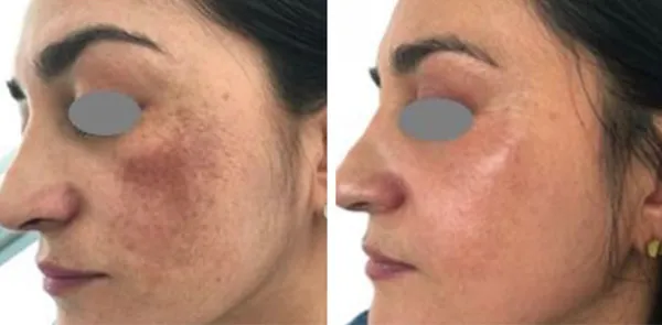 traitement-laser-melasma-fotona-algarve-portugal-01