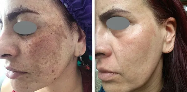 traitement-laser-melasma-almancil-algarve-02