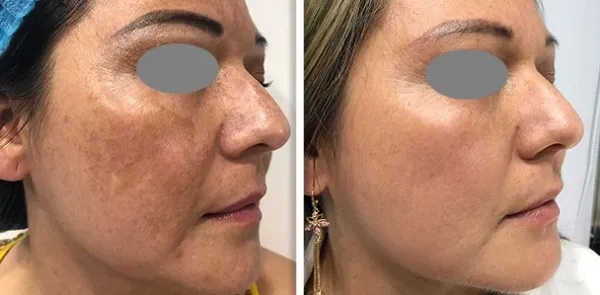 traitement-laser-melasma-moderne-algarve-portugal-03
