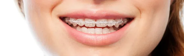 clear-ceramic-braces-almancil-faro-algarve-01